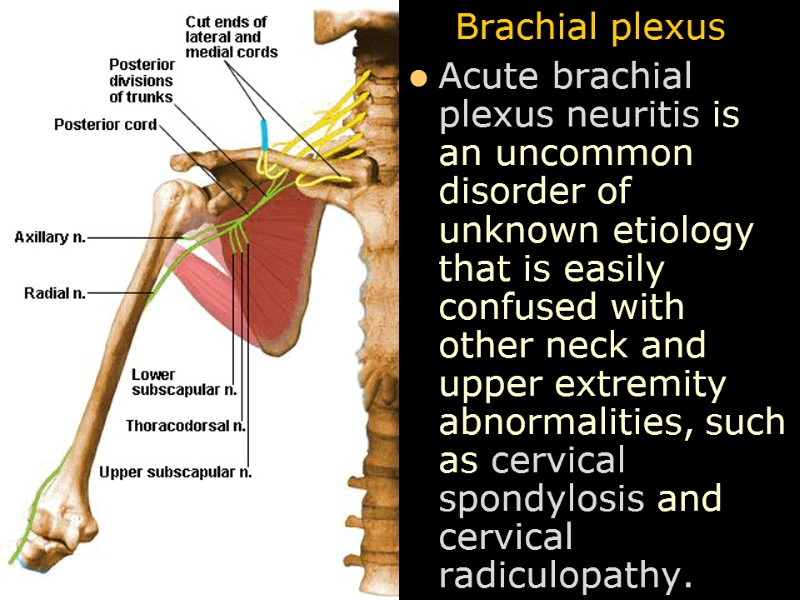 Brachial plexus  Acute brachial plexus neuritis is an uncommon disorder of unknown etiology